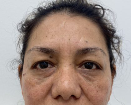 Eye Lift Before & After Patient #1223
