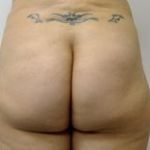 Brazilian Butt Lift Before & After Patient #1191