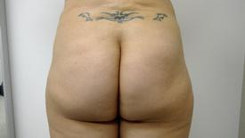 Brazilian Butt Lift Before & After Patient #1191