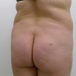 Brazilian Butt Lift Before & After Patient #1194