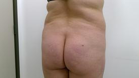 Brazilian Butt Lift Before & After Patient #1194