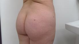 Brazilian Butt Lift Before & After Patient #1194