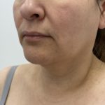 Facial Fillers Before & After Patient #1167