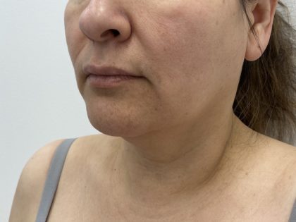Facial Fillers Before & After Patient #1167