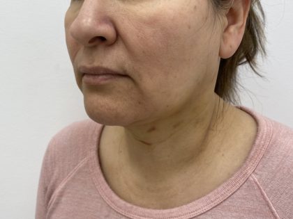 Facial Fillers Before & After Patient #1167