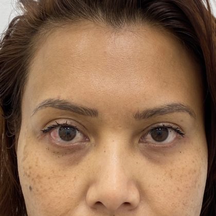Under Eye Fillers Before & After Patient #1172