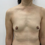 Breast Augmentation Before & After Patient #1251