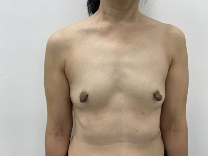 Breast Augmentation Before & After Patient #1251