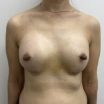 Breast Augmentation Before & After Patient #1251
