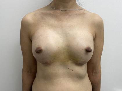 Breast Augmentation Before & After Patient #1251