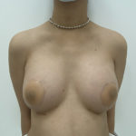 Breast Augmentation Before & After Patient #1248