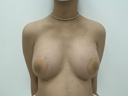 Breast Augmentation Before & After Patient #1248