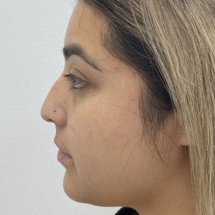 Non-Surgical Rhinoplasty Before & After Patient #1295