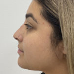 Non-Surgical Rhinoplasty Before & After Patient #1295