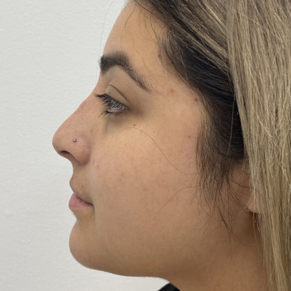 Non-Surgical Rhinoplasty Before & After Patient #1295