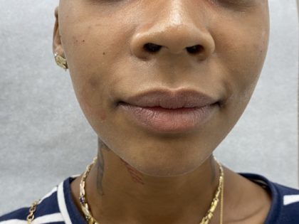 Lip Fillers Before & After Patient #1352