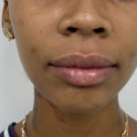 Lip Fillers Before & After Patient #1352