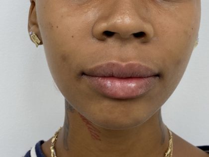 Lip Fillers Before & After Patient #1352