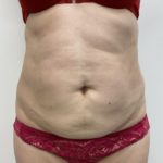 Liposculpture Before & After Patient #1355