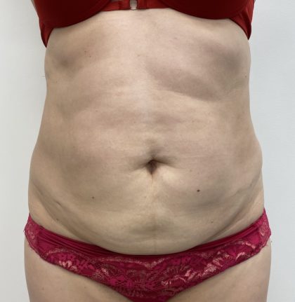 Liposculpture Before & After Patient #1355