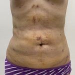 Liposculpture Before & After Patient #1355