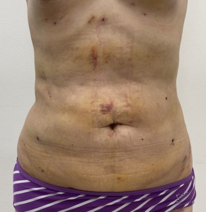 Liposculpture Before & After Patient #1355