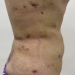 Liposculpture Before & After Patient #1355