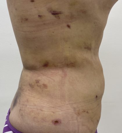 Liposculpture Before & After Patient #1355