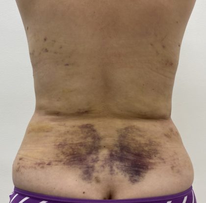 Liposculpture Before & After Patient #1355