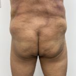 Fat Transfer Before & After Patient #1362