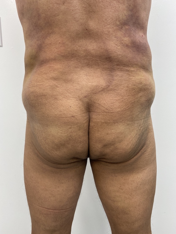 Fat Transfer Before & After Patient #1362