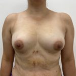 Fat Transfer Before & After Patient #1365