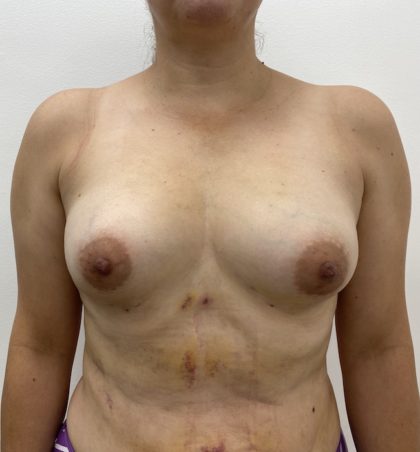 Fat Transfer Before & After Patient #1365