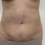 Liposculpture Before & After Patient #1370