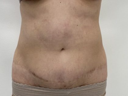 Liposculpture Before & After Patient #1370