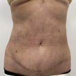 Liposculpture Before & After Patient #1370