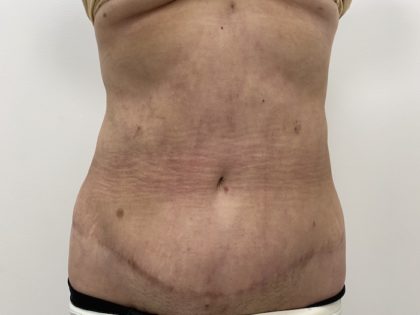 Liposculpture Before & After Patient #1370