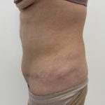 Liposculpture Before & After Patient #1370