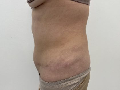 Liposculpture Before & After Patient #1370