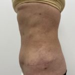 Liposculpture Before & After Patient #1370