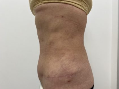 Liposculpture Before & After Patient #1370