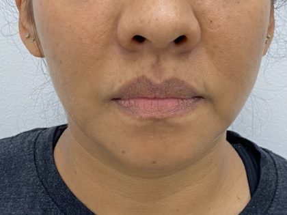 Lip Fillers Before & After Patient #1376