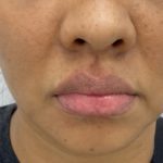 Lip Fillers Before & After Patient #1376