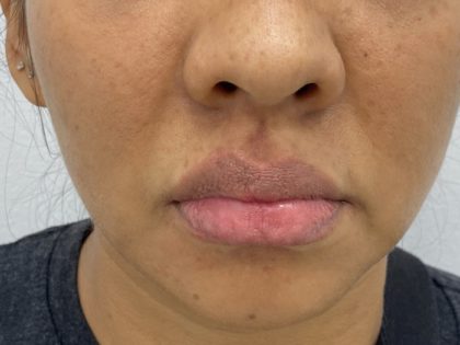 Lip Fillers Before & After Patient #1376