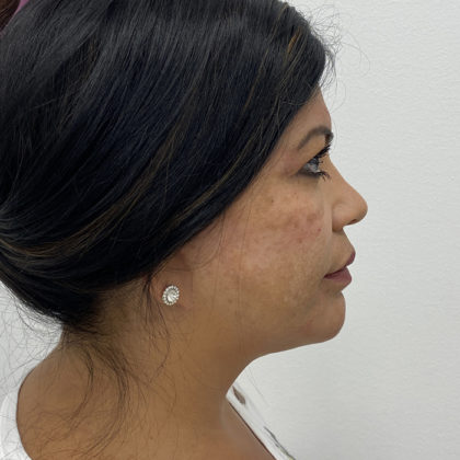 Facial Fillers Before & After Patient #1381