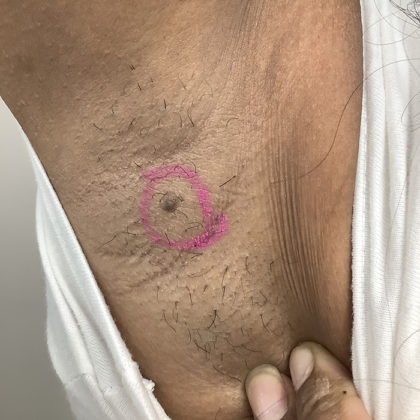 Mole Removal Before & After Patient #1384