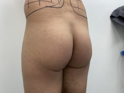 Brazilian Butt Lift Before & After Patient #1387