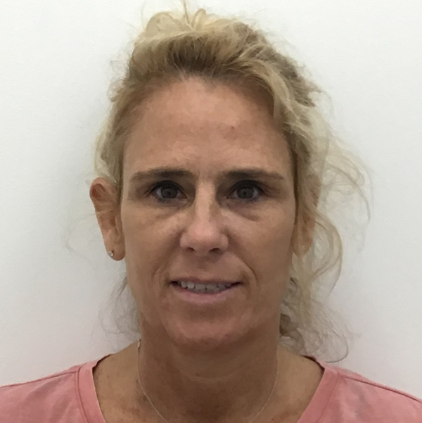 Under Eye Fillers Before & After Patient #1324
