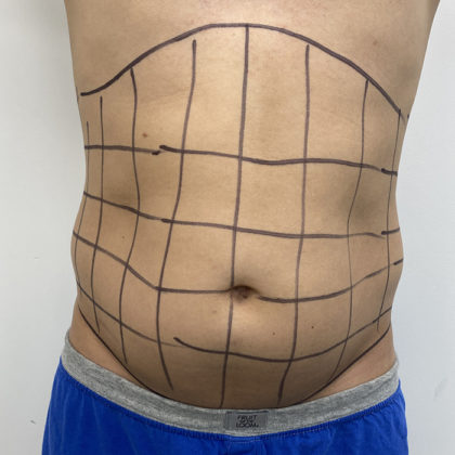 Liposculpture Before & After Patient #1396