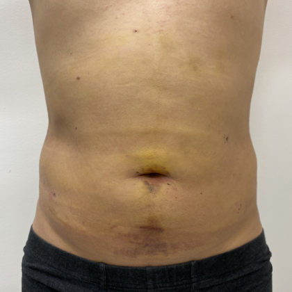 Liposculpture Before & After Patient #1396